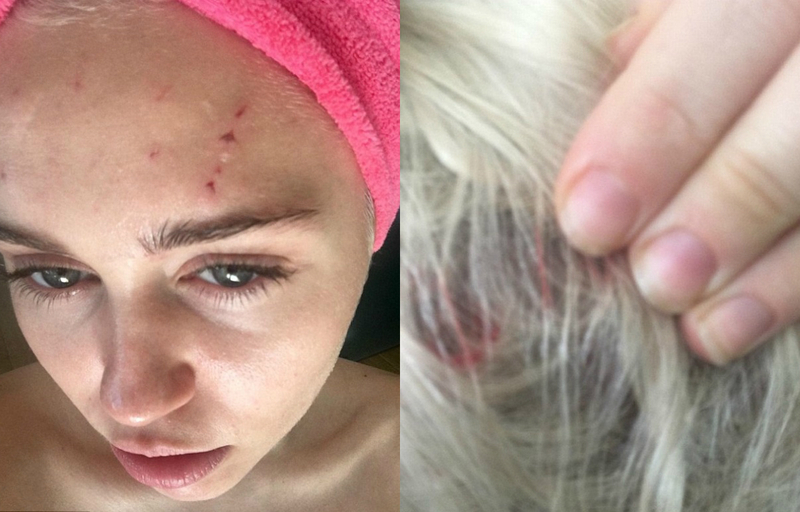 Майли Сайрус показала исцарапанное лицо, руку и голову